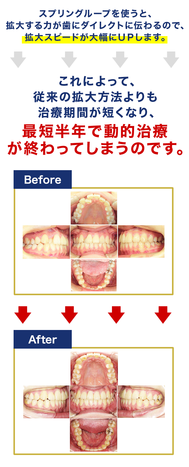 スプリングループを使うと、拡大する力が歯にダイレクトに伝わるので、拡大スピードが大幅にＵＰします。これによって、従来の拡大方法よりも治療期間が短くなり、最短半年で動的治療が終わってしまうのです。矯正法ビフォーアフター画像